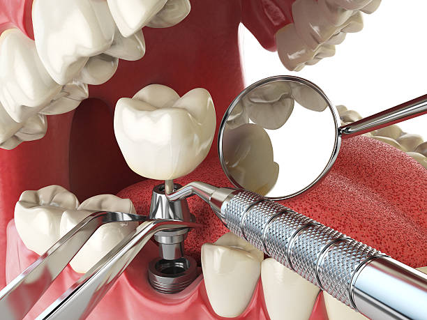 Best Emergency Wisdom Teeth Removal in Danville, PA